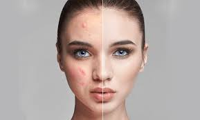 Dacă ai pielea sensibilă şi nu eşti interesată de produsele cosmetice speciale cu efect antiacneic, iată 10 soluţii de a scăpa de coşuri în mod natural, pe mati putea ajuta careva a ancercat ceva pentru ten gras am obiceiul sa le sparg nu le pot vedea si se face cate unu sub piele tare si dureros dac ati. Totul Despre Acnee Cauze Preventie Si Tratament Derma Expert By Elos