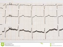 Arrhythmia Stock Image Image Of Heart Graph Chart 30102671