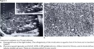 The grades are used by doctors to estimate the severity of the changes on ultrasound with grade 1 being mild and grade 4 being severe. Pdf Renal Parenchymal Disease Sonographic Histologic Correlation 1 Semantic Scholar