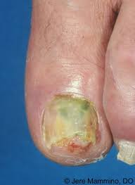 Acrylic nails often get a lot of bad press. Green Nail Syndrome American Osteopathic College Of Dermatology Aocd