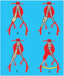 We sought to evaluate the midterm efficacy of bbt by using different stent grafts in the treatment of aaa combined with iliac artery. Scielo Brasil Endovascular Therapeutic Options For The Treatment Of Aortoiliac Aneurysms Endovascular Therapeutic Options For The Treatment Of Aortoiliac Aneurysms
