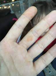 What is the cause of this? Rust Colored Splotches On Hands Babycenter