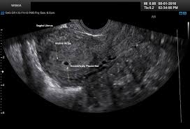 Diagnostic Ultrasound In The First Trimester Of Pregnancy