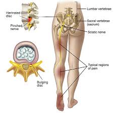 Quickly tighten the buttocks, strengthen muscles allow the following 2 exercises. Sciatica A Pain In The Bum Literally Equilibrium Sports And Spinal Clinic