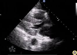 Image result for Left Ventricular Outflow Obstruction