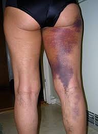 Bruise Wikipedia