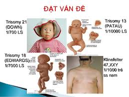 It is three times more common in girls than boys. Encyclopedia Of Medicine Edwards Syndrome