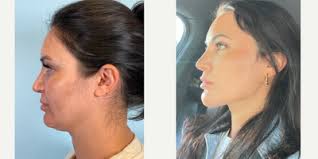 Benjamin Caughlin, MD, FACS Reviews, Before and After Photos, Answers