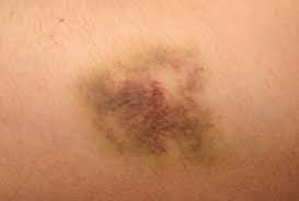 When white spots on skin can just be a cosmetic thing sometimes, this condition rarely is. Bruising Symptoms Causes Treatments