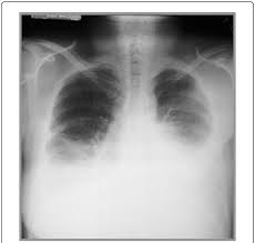 She had received treatment on lines of chronic liver disease, congestive heart failure but did not manifest any improvement. Chest X Ray Showing Bilateral Pleural Effusion Download Scientific Diagram