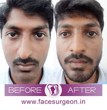 See full list on indicure.com Cost Of Nose Job In India Cosmetic Rhinoplasty In India