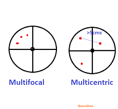 Multifocal Vs Multicentric Breast Cancer Random Reflections Of A Breast Cancer Surgeon