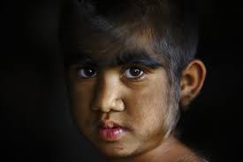 In case you were wondering, werewolf syndrome is an unfamiliar discovered disease that is actually called hypertrichosis. Family With Werewolf Syndrome Undergoes Laser Hair Removal Photos