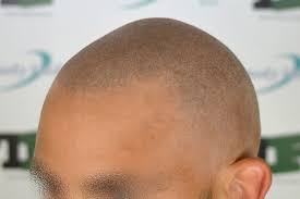 Quando si parla di micropigmentazione ci si riferisce a una specifica. Micropigmentazione Tricopigmentazione