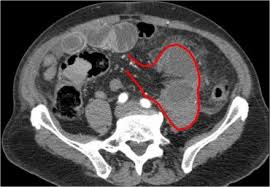 Pin By Omar Serhan On Diagnostic Medical Imaging Small Bowel Obstruction Bowel Obstruction Obstruction