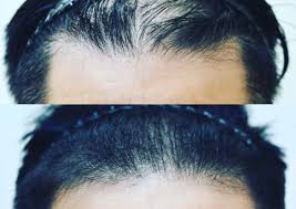 When it reaches a length of about 25cm or 10in, the growth rate will slow down to about 6mm or 1/4in per month. 3 Best Hair Loss Treatment Clinics In Singapore 2021