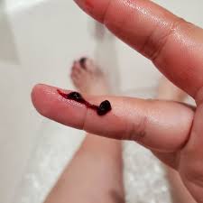 Is This A Normal Clot Of Miscarriage Gross Pics