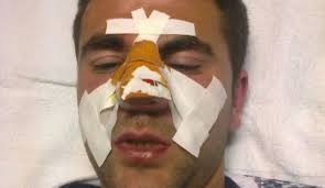 Au dat în mine ca într-un animal“: Arbitrul Marian Carson, operat după  bătaia primită la un meci jucat la Ovidiu