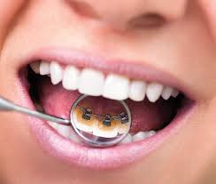Wire cutters are meant to make clean, fast cuts for just about any type of wire. Lingual Braces An Invisible Way To Straighten Teeth
