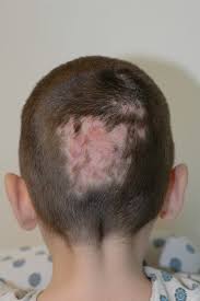 Image result for sores on the head in children