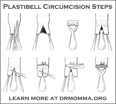 pin on how circumcision happens