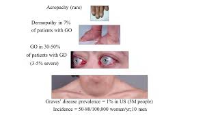 Graves' disease is an autoimmune disorder that causes hyperthyroidism, or the overproduction of thyroid hormones, according to the national institute of diabetes and digestive and kidney diseases. The Pyramidal Structure Of The Graves Disease Syndrome Download Scientific Diagram