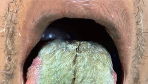 Image result for black hairy tongue symptoms