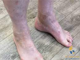 It allows bones to glide over one another. Sprunggelenksarthrose Osg Verschleiss Fussspezialist Dr M Nastai