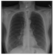 In patients with emphysema, changes can include lung hyperinflation manifested as a flat. Chronic Obstructive Pulmonary Disease Update 2016 03 07 Ahc Media Continuing Medical Education Publishing