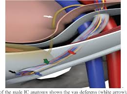 #diagram of groin area male #diagram of groin muscle in human male #groin diagram female #groin diagram male #hamstring diagram #pelvis diagram #upper leg muscles diagram. Figure 3 From Radiological Anatomy Of Groin Region And Radiological Diagnosis Of Inguinal Hernia Semantic Scholar