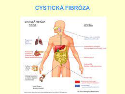 Cystická fibróza (cf) neboli mukoviscidóza je lidské geneticky podmíněné onemocnění, které postihuje převážně dýchací a trávicí soustavu. Cysticka Fibroza Wikipedia