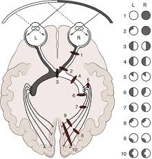 Image result for Visual Field Deficit