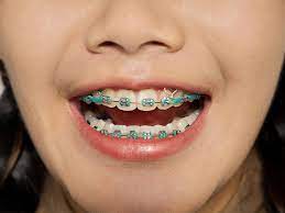 Help your child apply the medication using a cotton swab or a clean finger. Braces With Rubber Bands Purpose And How Long They Stay On