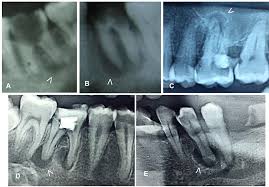 Image result for granuloma gum disease
