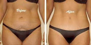 When Can You Have A Tummy Tuck After C Section Pin On Liposuction Before And After