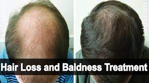 The yolk may be especially useful to moisturize hair that appears dry. Hair Loss And Baldness Treatment At Home With Honey And Egg Yolk Bald Head Treatment Youtube