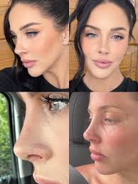 Successful septorhinoplasty surgery experience