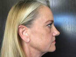 BBL™ Photofacial Before and Afters