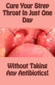 Cure Your Strep Throat In Just One Day Without Taking Any Antibiotics Holistic Remedies Health The Cure