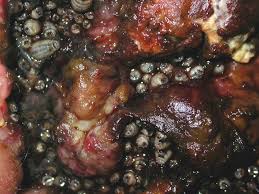 Myasis atau belatungan adalah infestasi larva lalat ke dalam suatu jaringan hidup. Myiasis Clinical Microbiology Reviews