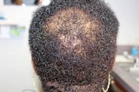 Our formula blends quality african black soap, bamboo charcoal, tea tree oil, and willow bark extract with certified organic shea butter to create a winning hair wash that helps soothe that annoying scalp. Hair Loss The Skin Skoop