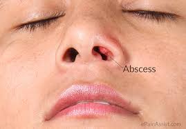 Minor infections at the opening of the nose, called nasal vestibulitis, may result in pimples at the base of nasal hairs (folliculitis) and sometimes crusts around the nostrils. Nasal Vestibulitis Treatment Causes Signs Symptoms Risk Factors