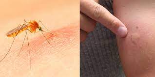 In general, the insect stings in series of 3 or 4 pits aligned or. Bug Bites Pictures Symptoms Treatment And Prevention