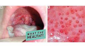 A sore throat is pain, scratchiness or irritation of the throat that often worsens when you swallow. This 9 Year Old Girl S Strep Throat Showed Up As Tiny Doughnut Lesions