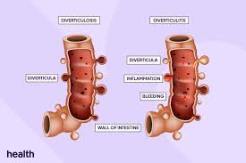 Image result for Diverticulitis