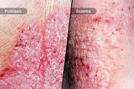Image result for psoriasis