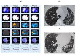 Maybe you would like to learn more about one of these? Jcm Free Full Text Evaluation Of Regional Pulmonary Ventilation In Spontaneously Breathing Patients With Idiopathic Pulmonary Fibrosis Ipf Employing Electrical Impedance Tomography Eit A Pilot Study From The European Ipf Registry