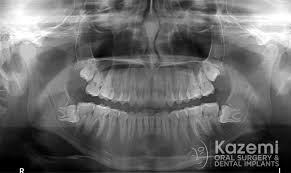 The bone can take up to 6 months to heal can dental bone grafting save your teeth? When To Consider Bone Graft For Impacted Wisdom Teeth When To Consider Bone Graft For Impacted Wisdom Teeth Kazemi Oral Surgery Facialart Com