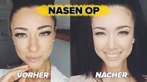 Meine Nasen Op Danach Vorher Nacher Fotos Kosten Youtube