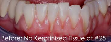 This Is A Pretreatment Photo Of The Lower Front Teeth Treated With Pin Hole Li Gum Rejuvenation By Dr Chao The Invent The Inventors Gum Recession Front Teeth